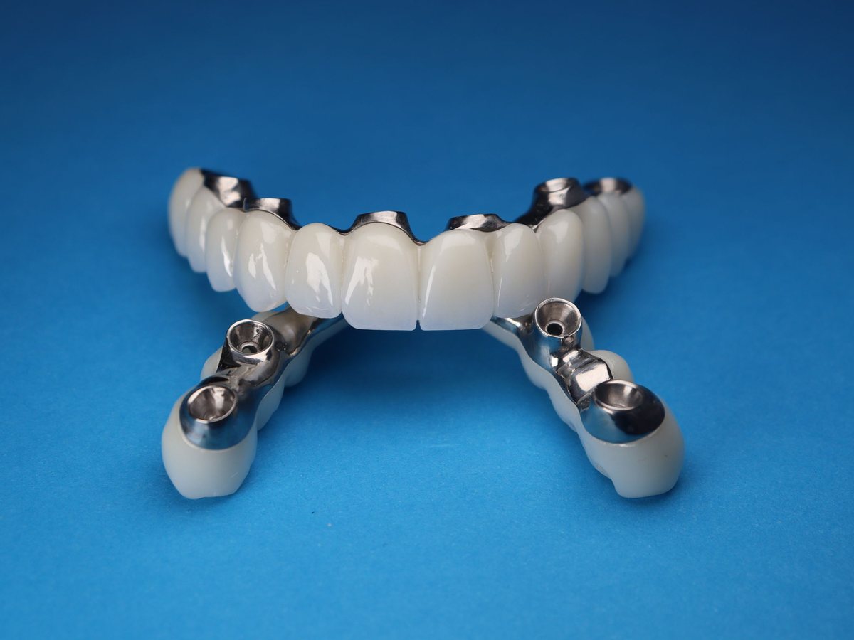 Mavi zemin üzerinde metal bağlantı parçaları görünen implant üstü tam çene diş protezi